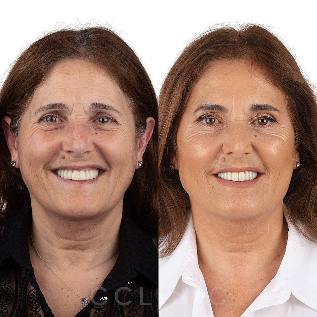 Rejuvenescimento Facial